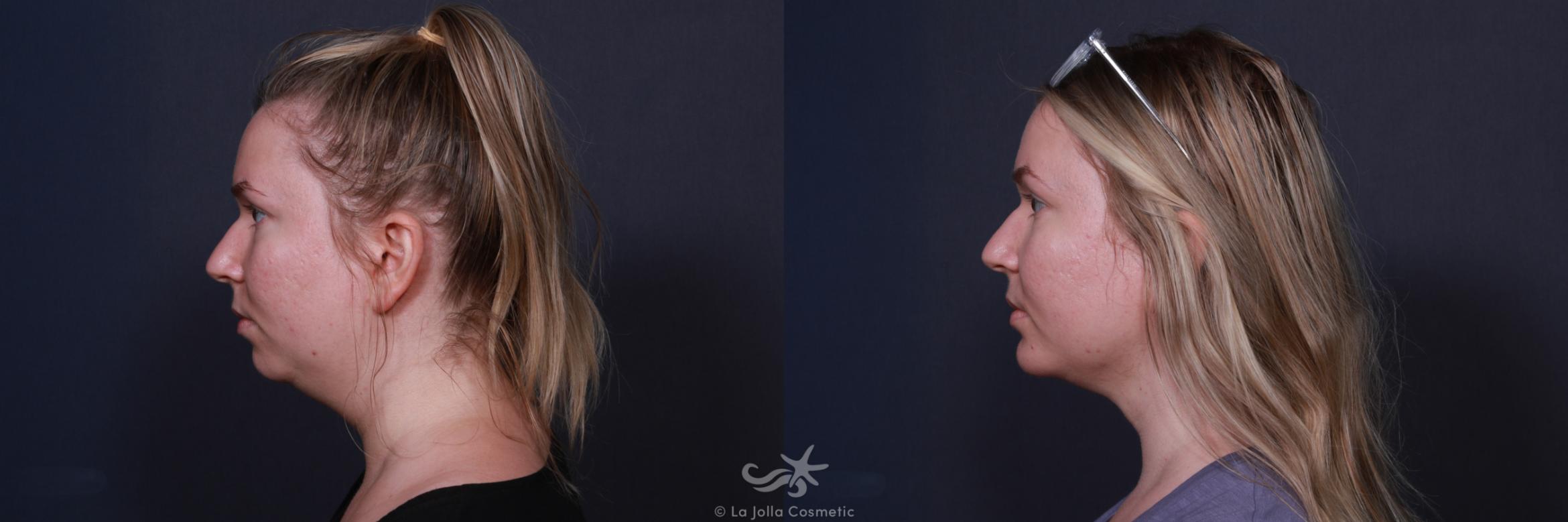 Before & After Chin Enlargement Result 221 Left Side View in San Diego, CA