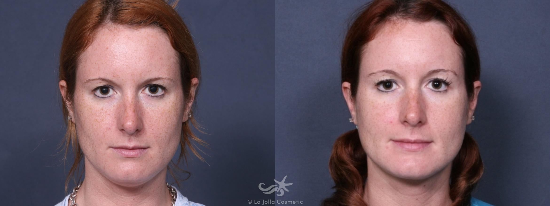 Before & After Chin Enlargement Result 425 Front View in San Diego, CA