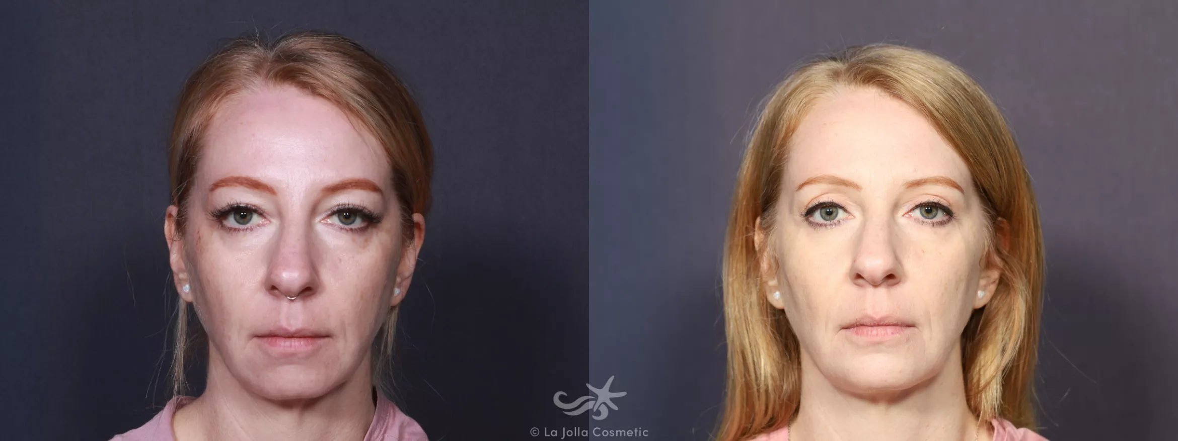 Before & After Chin Enlargement Result 743 Front View in San Diego, CA