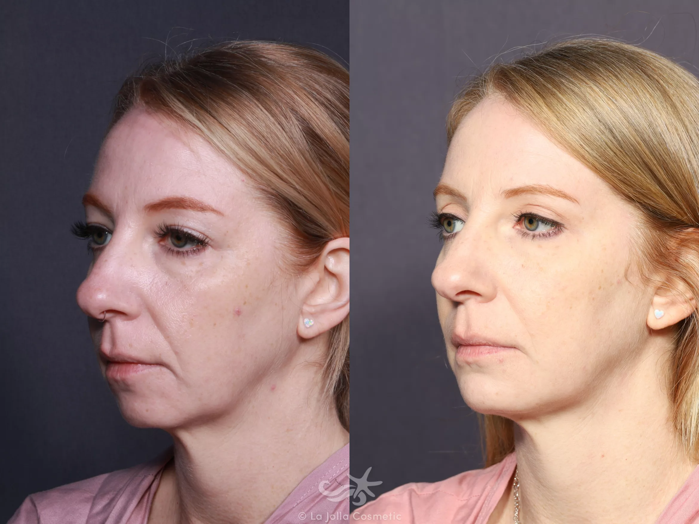 Before & After Chin Enlargement Result 743 Left Oblique View in San Diego, CA