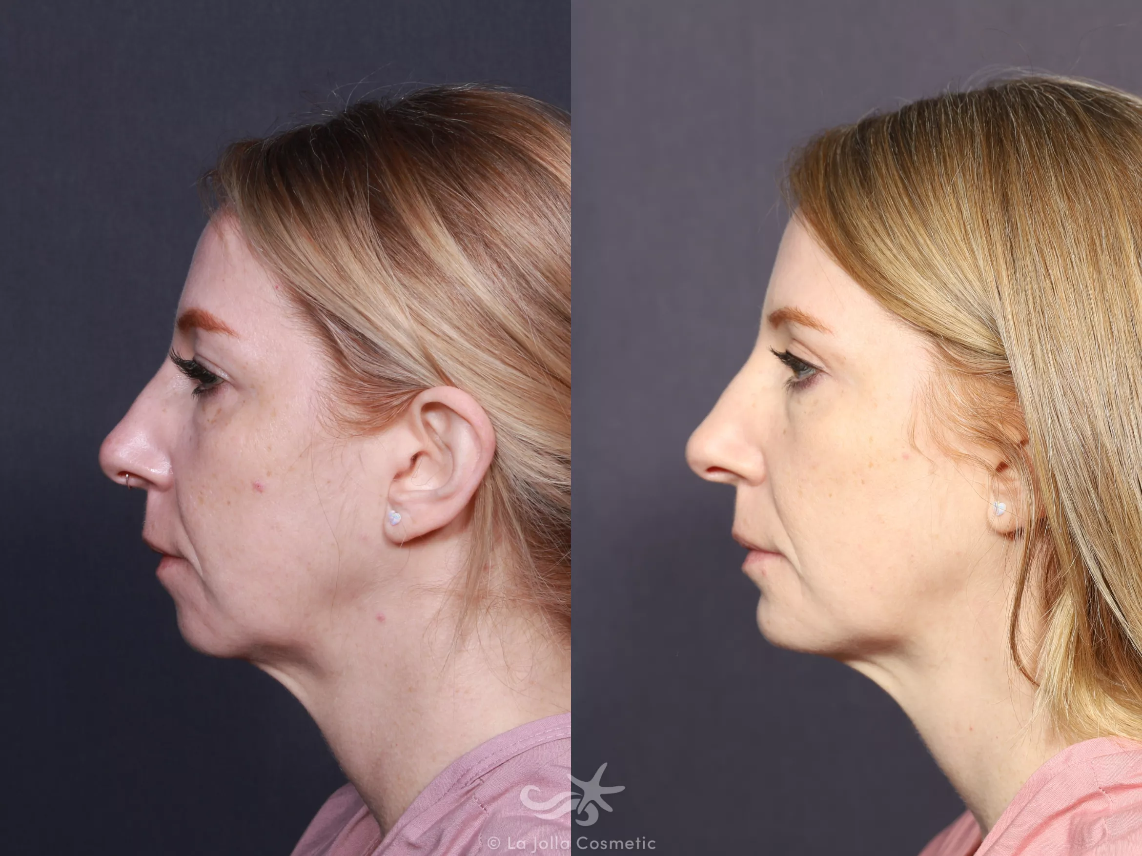 Before & After Chin Enlargement Result 743 Left Side View in San Diego, CA