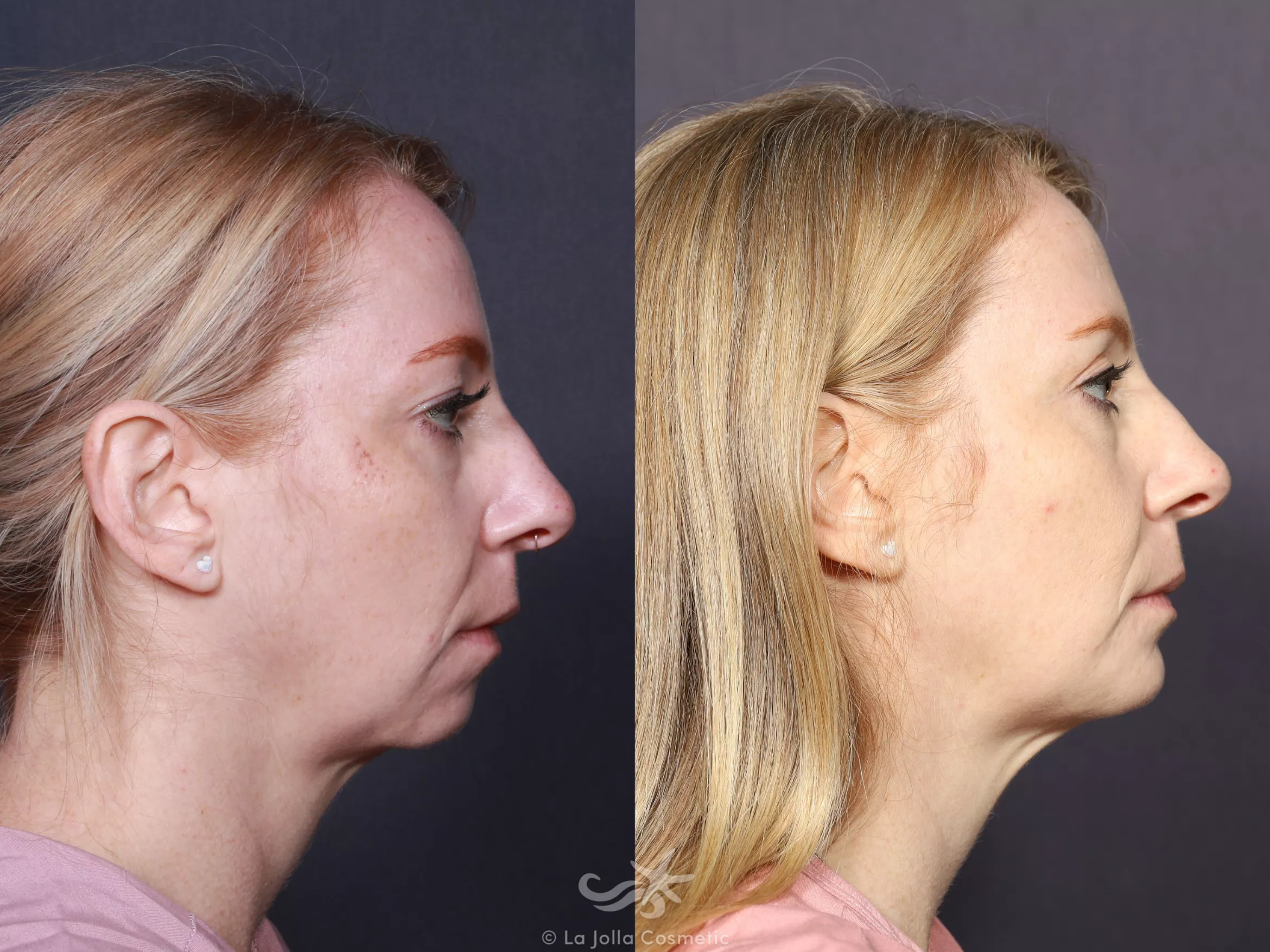 Before & After Chin Enlargement Result 743 Right Side View in San Diego, CA
