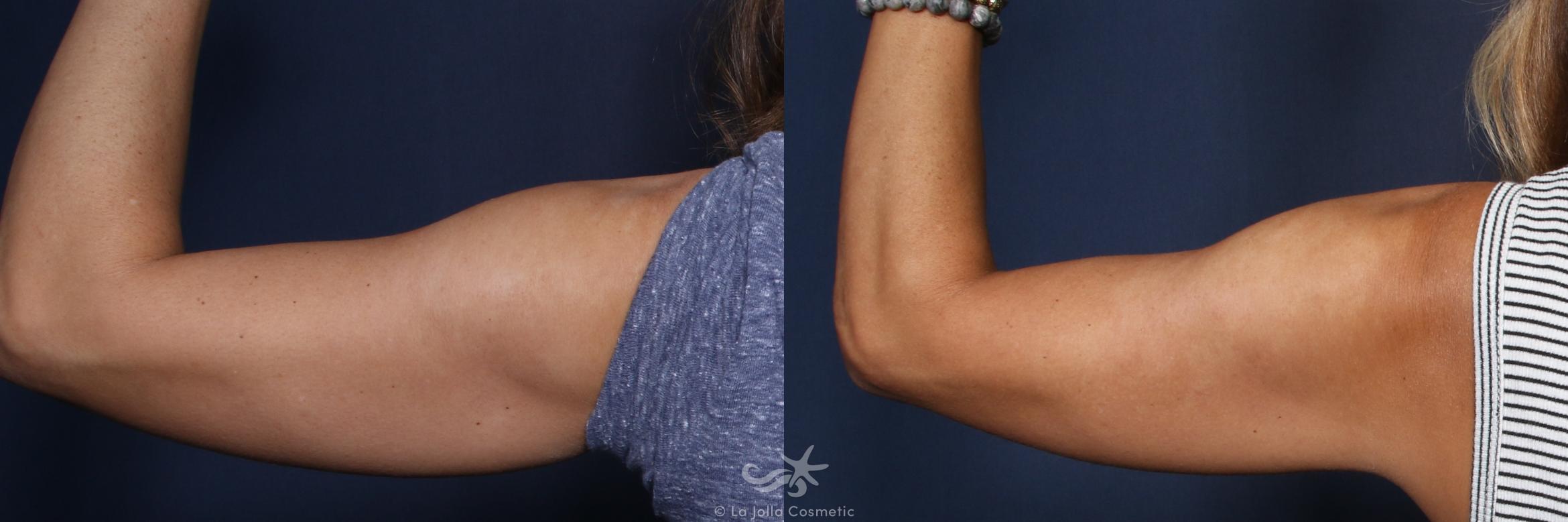 Before & After CoolSculpting® Result 136 Back Left Arm View in San Diego, CA
