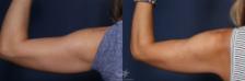Before & After CoolSculpting® Result 136 Back Left Arm View in San Diego, Carlsbad, CA