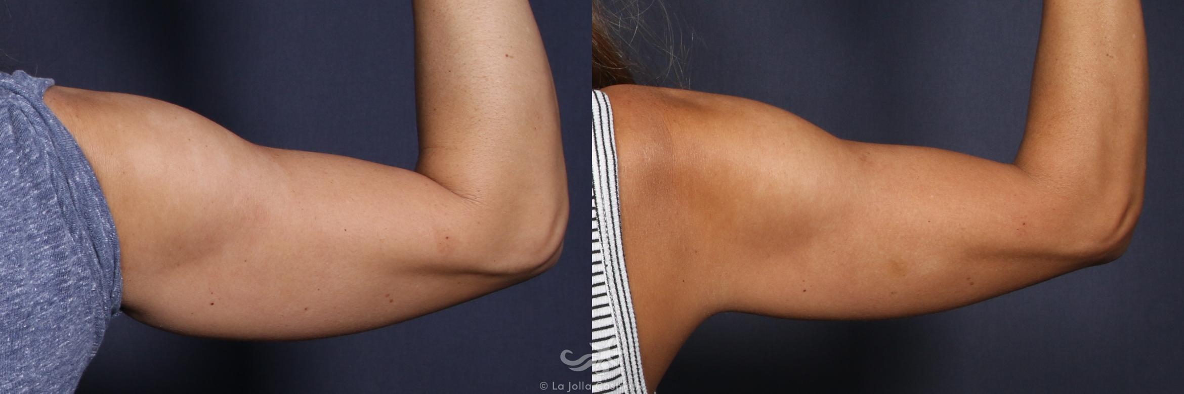 Before & After CoolSculpting® Result 136 Back Right Arm View in San Diego, CA