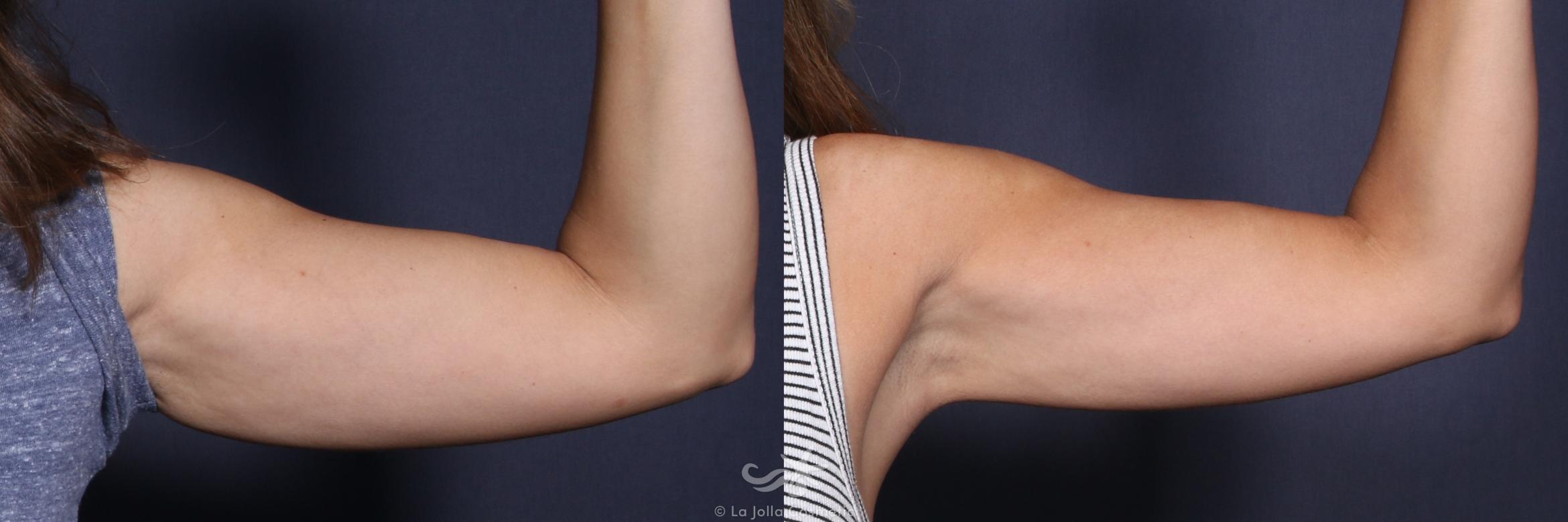 Before & After CoolSculpting® Result 136 Front Left Arm View in San Diego, CA