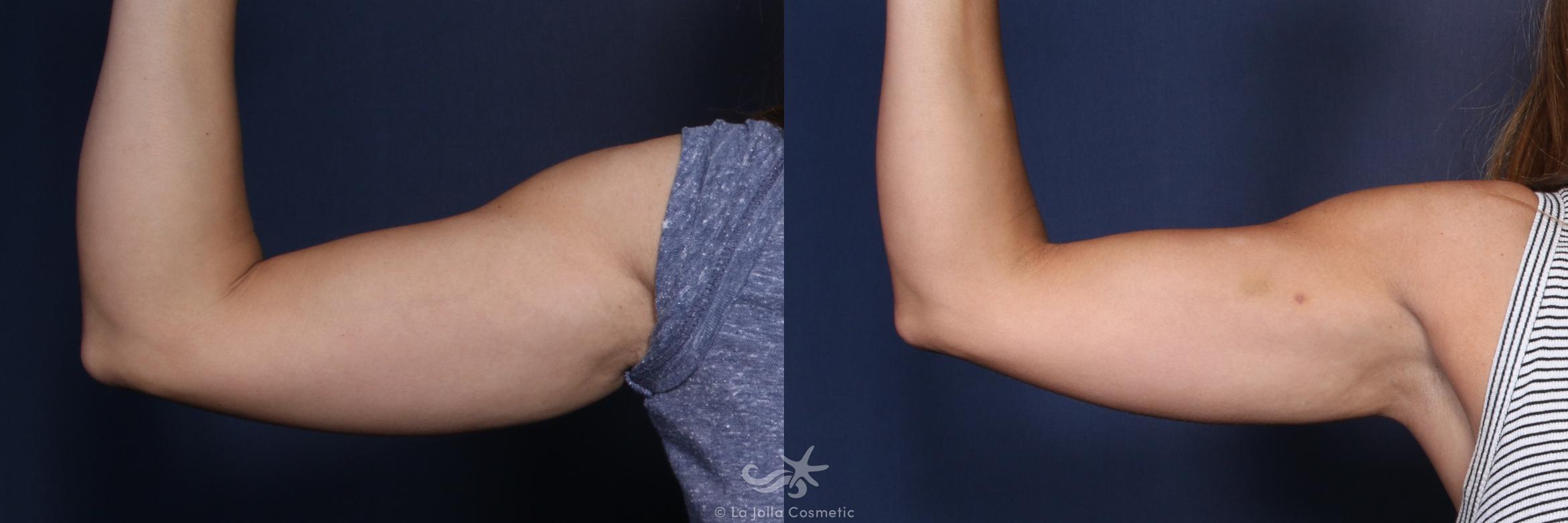 Before & After CoolSculpting® Result 136 Front Right Arm View in San Diego, CA