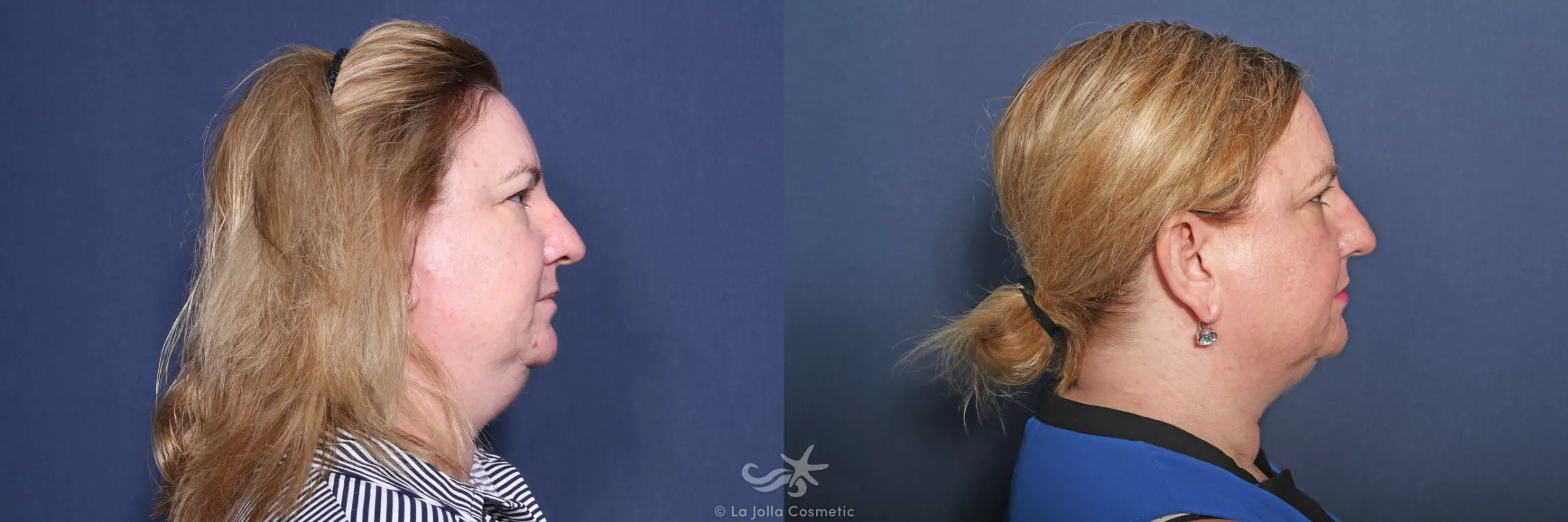 Before & After CoolSculpting® Result 538 Right Side View in San Diego, CA