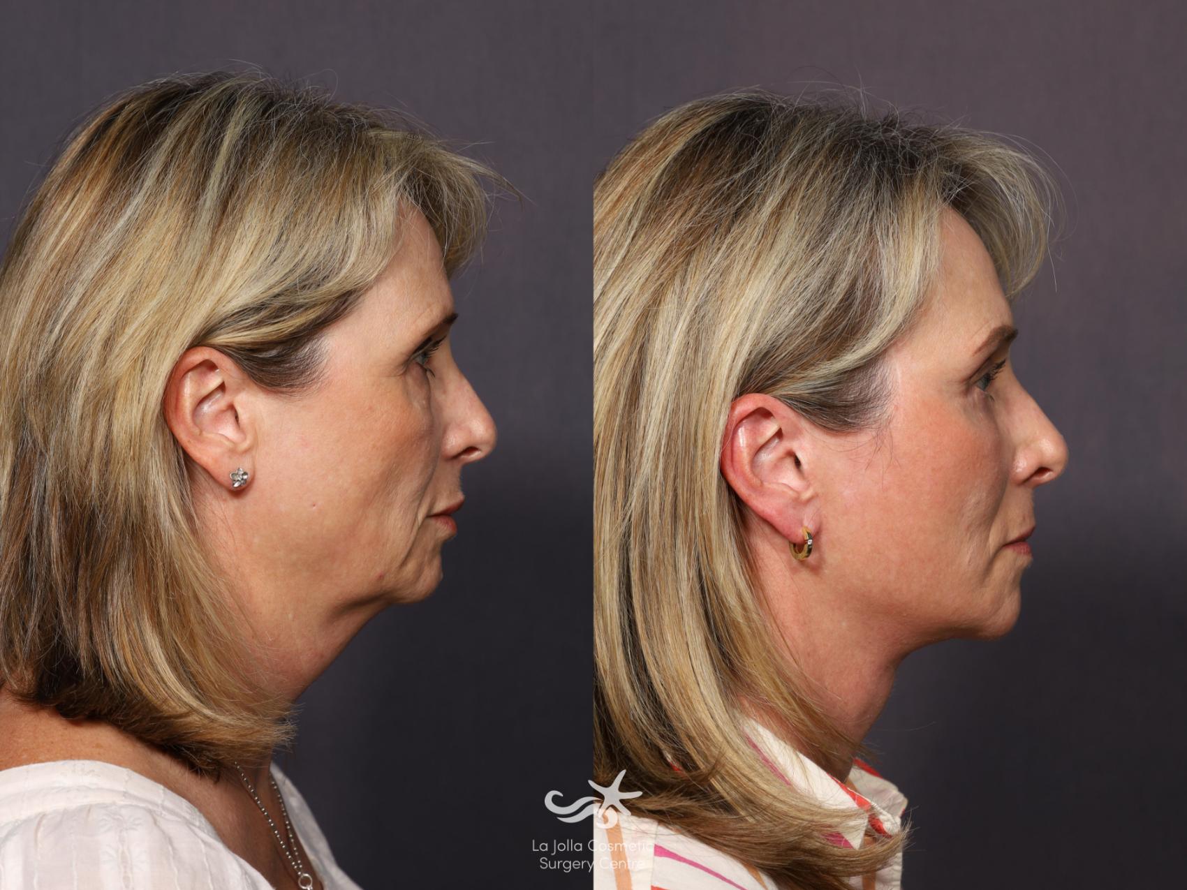 Before & After Deep Plane Facelift Result 1142 Right Side View in San Diego, CA