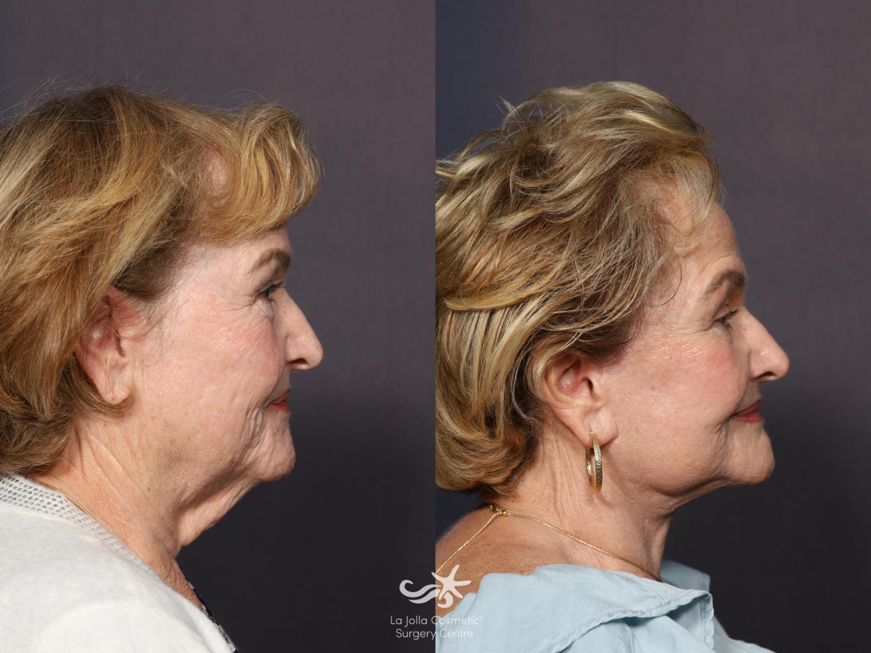 Before & After Deep Plane Facelift Result 1224 Right Side View in San Diego, CA