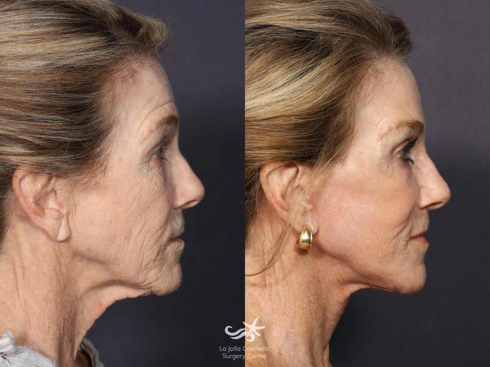 Before & After Deep Plane Facelift Result 664 Right Side View in San Diego, CA