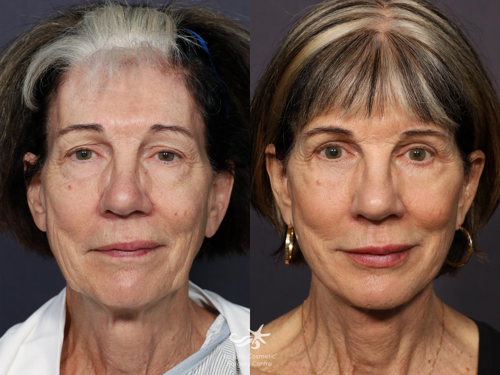 Before & After Deep Plane Facelift Result 722 Front View in San Diego, CA