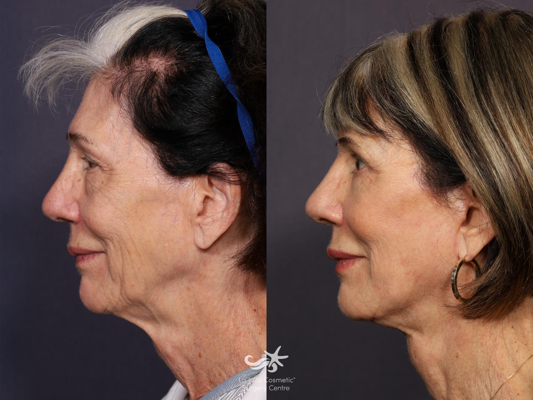 Before & After Deep Plane Facelift Result 722 Left Side View in San Diego, CA