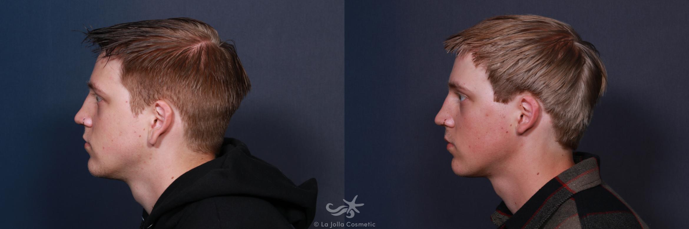 Before & After Earlobe Reduction Result 194 Left Side View in San Diego, CA
