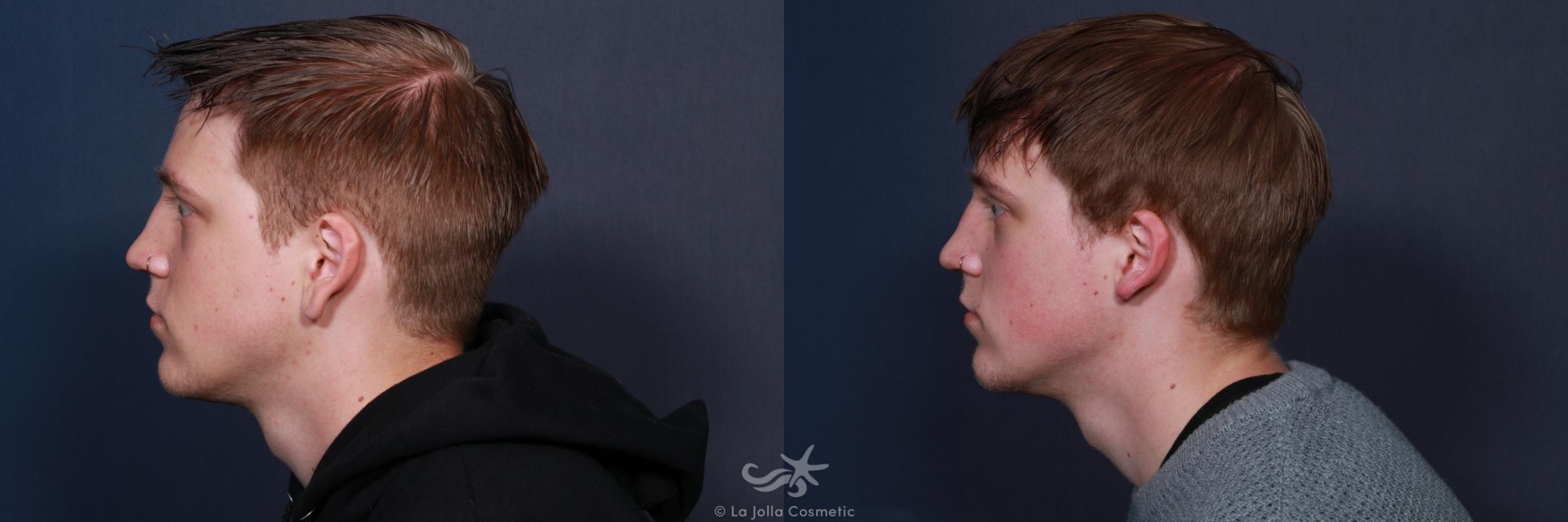 Before & After Earlobe Reduction Result 57 Left Side View in San Diego, CA