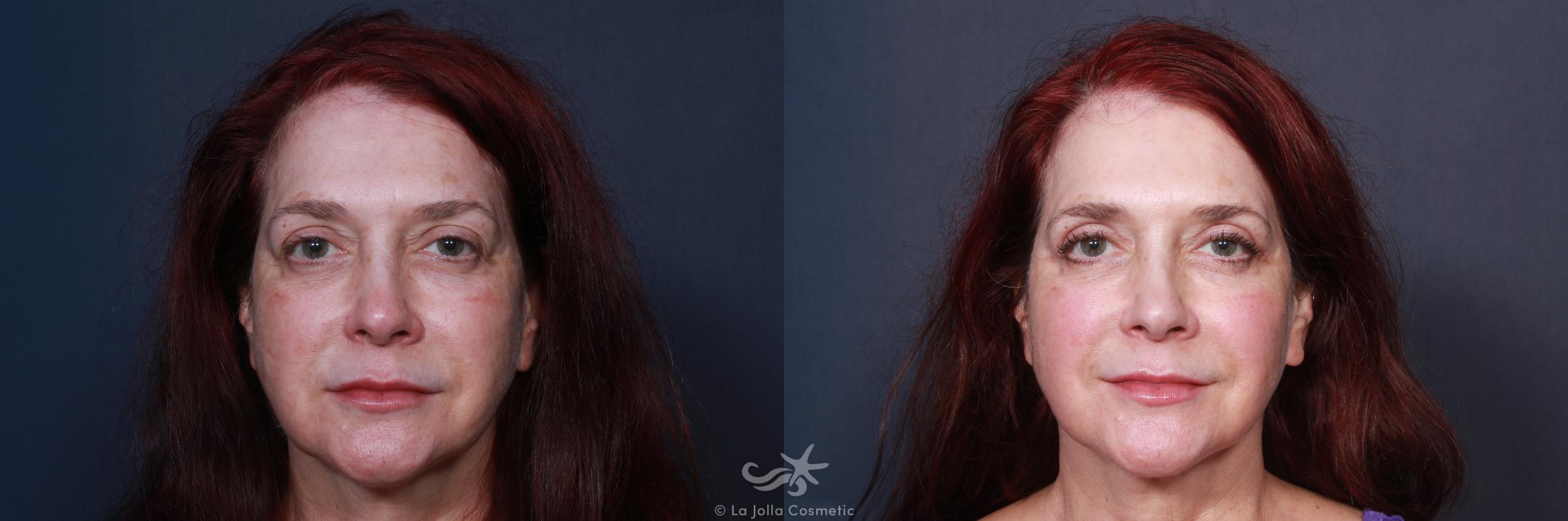 Before & After Eyelid Lift Result 112 Front View in San Diego, CA