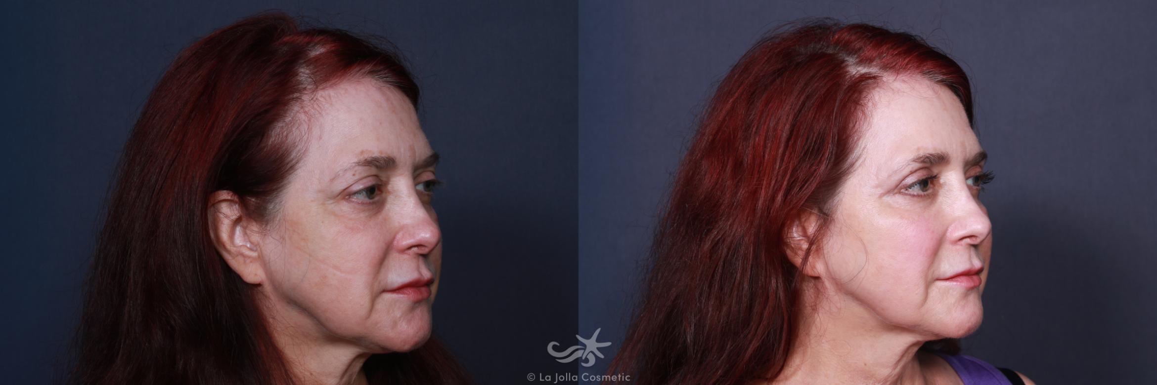 Before & After Eyelid Lift Result 112 Right Oblique View in San Diego, CA