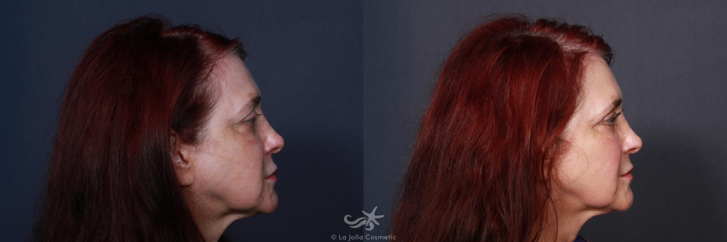 Before & After Eyelid Lift Result 112 Right Side View in San Diego, CA