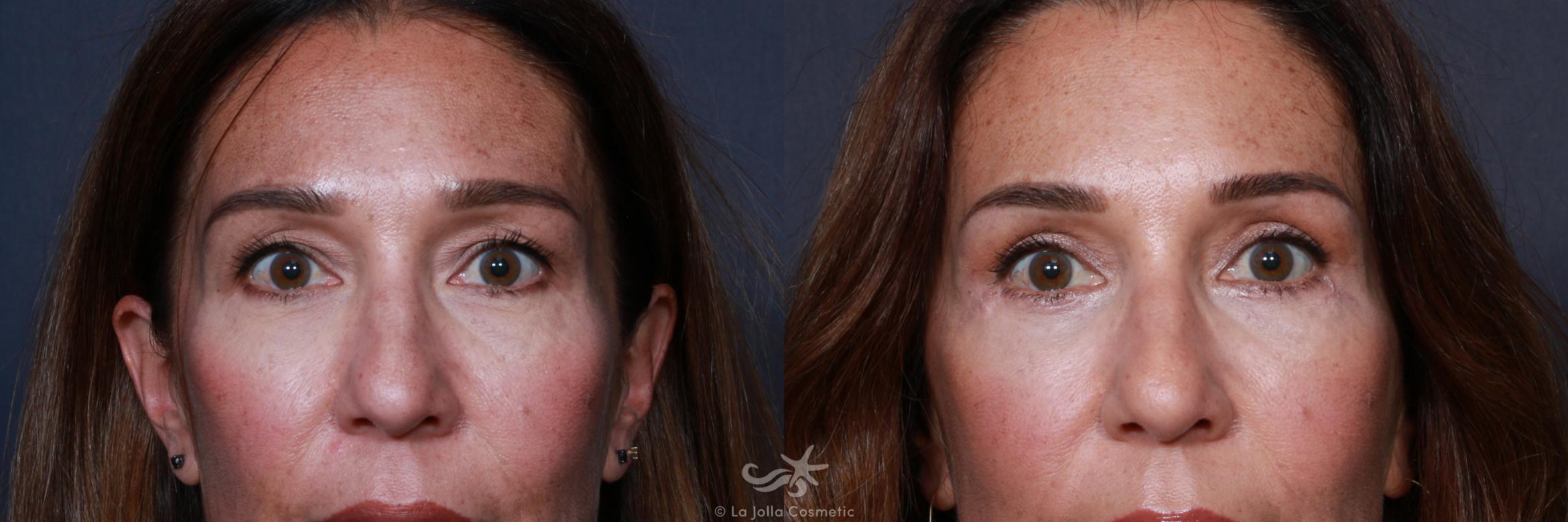 Before & After Eyelid Lift Result 182 Front View in San Diego, CA