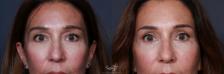Before & After Eyelid Lift Result 182 Front View in San Diego, Carlsbad, CA