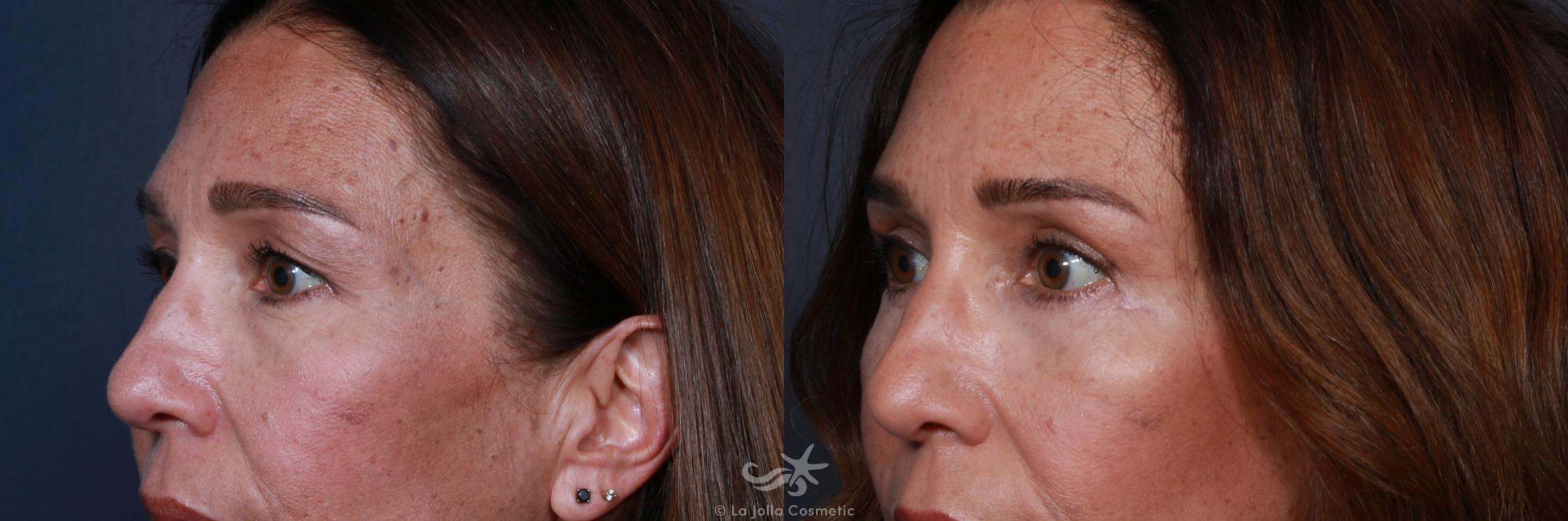 Before & After Eyelid Lift Result 182 Left Oblique View in San Diego, CA