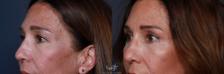 Before & After Eyelid Lift Result 182 Left Oblique View in San Diego, Carlsbad, CA