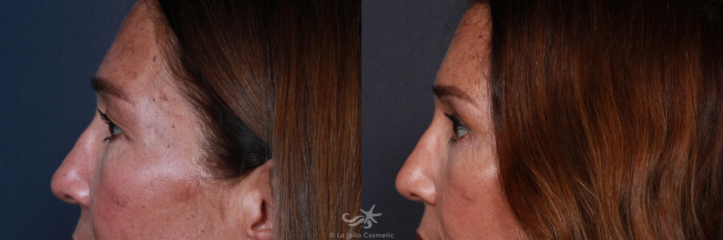 Before & After Eyelid Lift Result 182 Left Side View in San Diego, CA