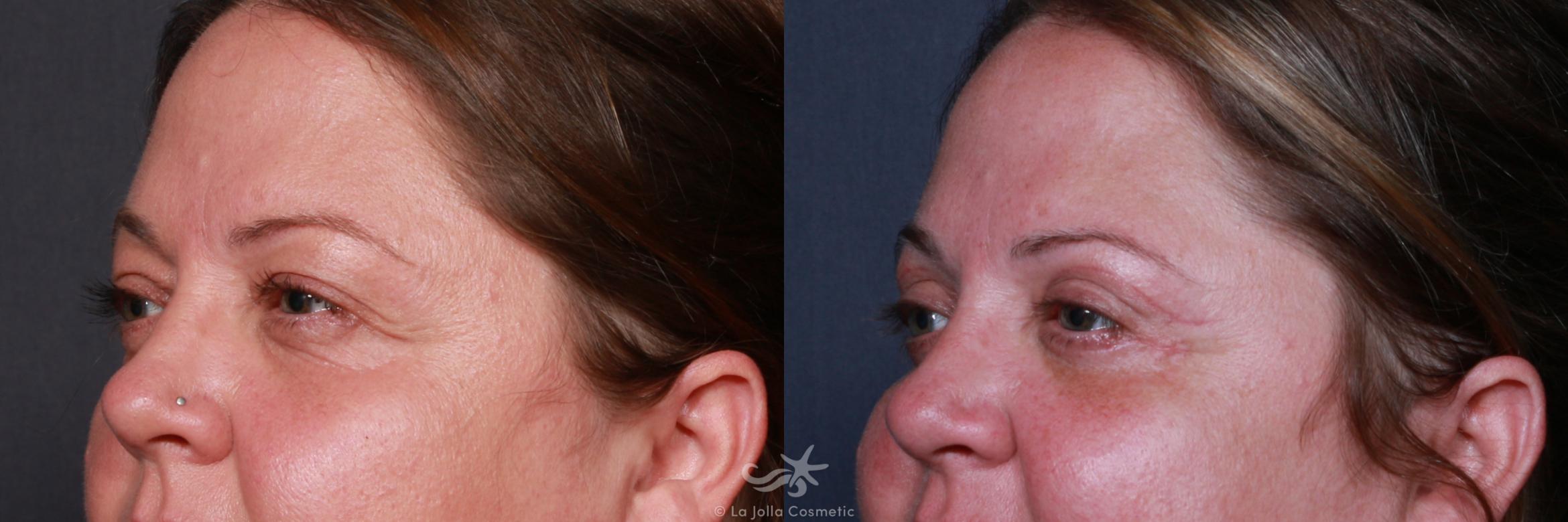 Before & After Eyelid Lift Result 192 Left Oblique View in San Diego, CA