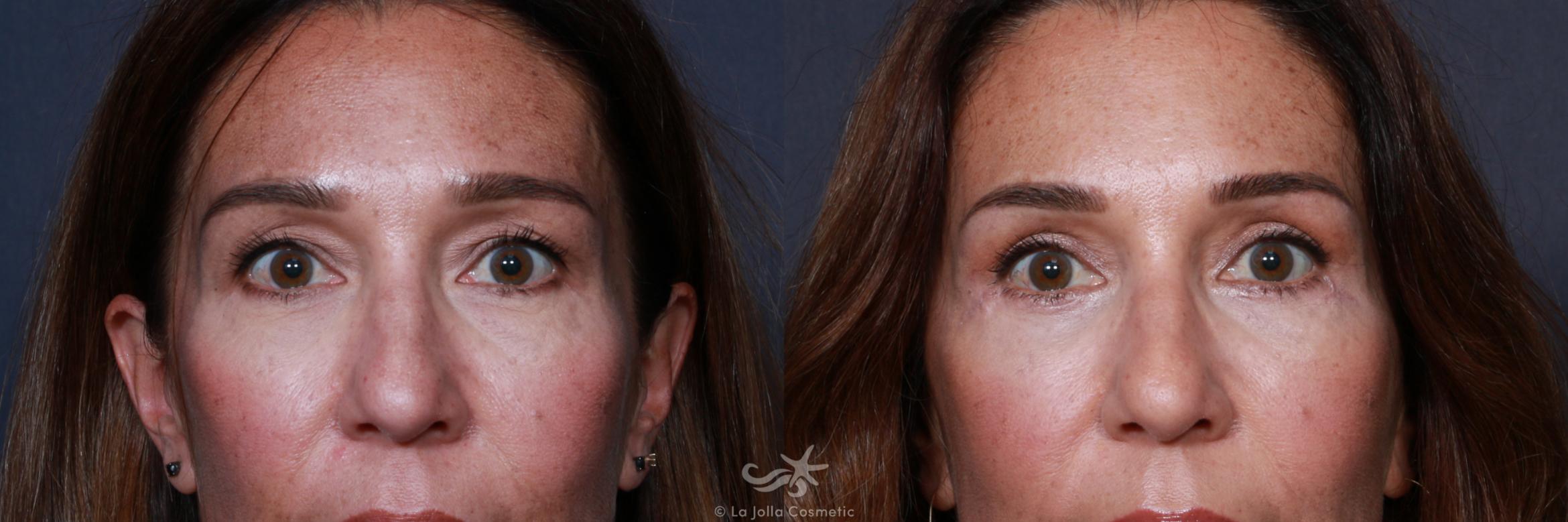 Before & After Eyelid Lift Result 205 Front View in San Diego, CA