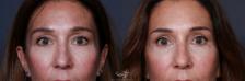 Before & After Eyelid Lift Result 205 Front View in San Diego, Carlsbad, CA