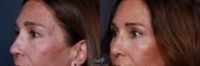 Before & After Eyelid Lift Result 205 Left Oblique View in San Diego, Carlsbad, CA