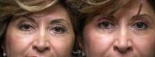 Before & After Eyelid Lift Result 249 Front View in San Diego, Carlsbad, CA