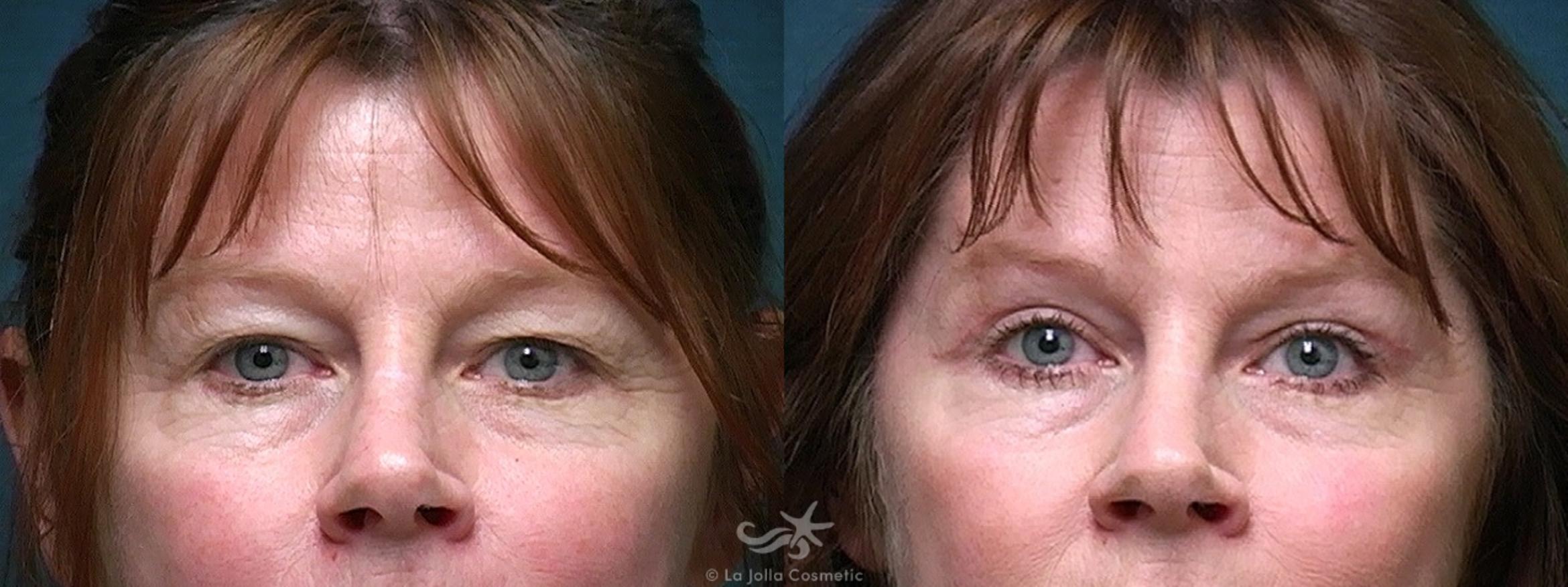 Before & After Eyelid Lift Result 255 Front View in San Diego, CA