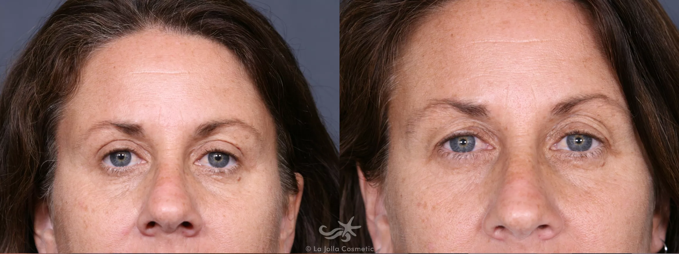 Before & After Eyelid Lift Result 348 Front View in San Diego, CA