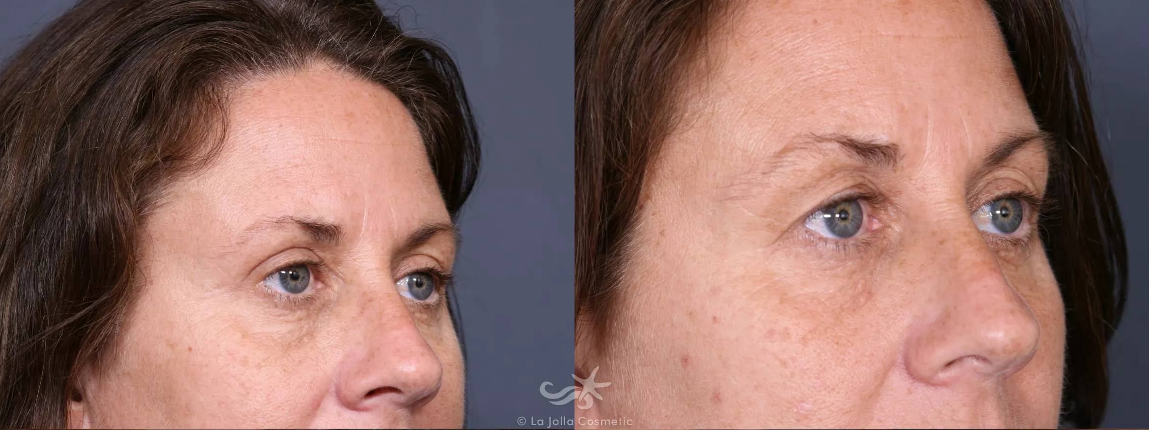 Before & After Eyelid Lift Result 348 Right Oblique View in San Diego, CA