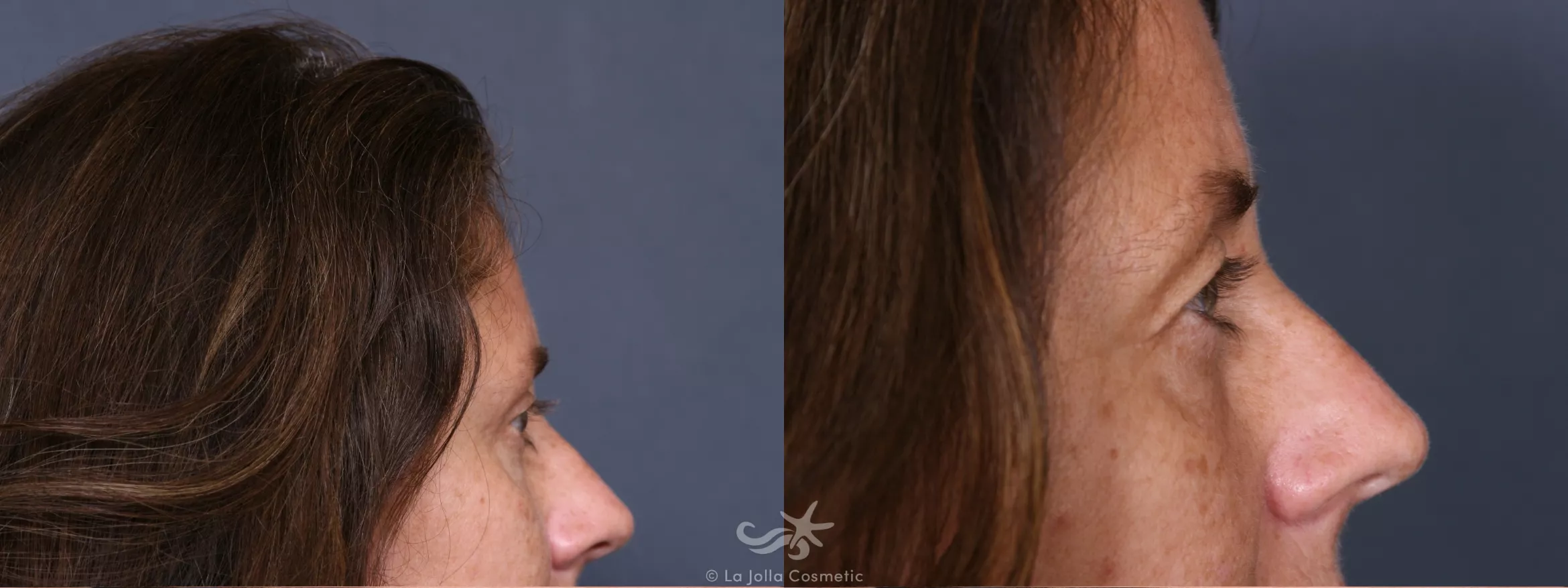 Before & After Eyelid Lift Result 348 Right Side View in San Diego, CA