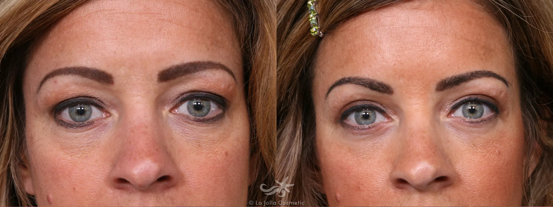 Before & After Eyelid Lift Result 357 Front View in San Diego, CA
