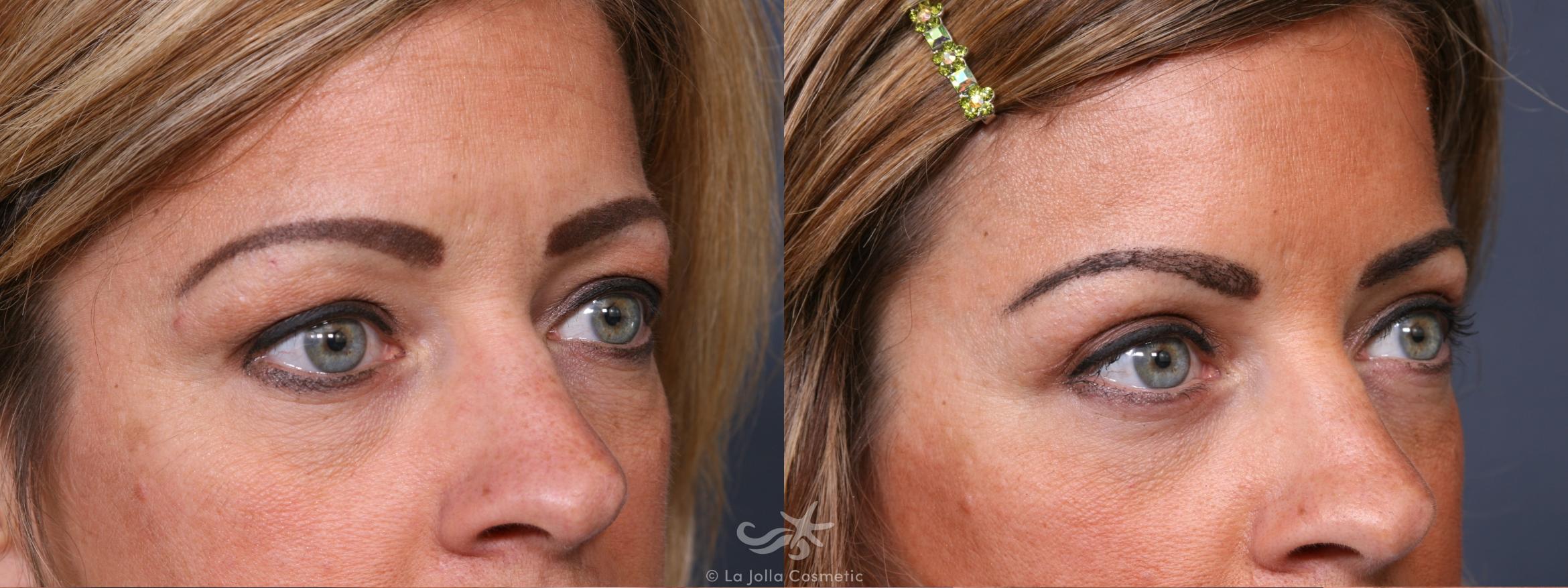 Before & After Eyelid Lift Result 357 Right Oblique View in San Diego, CA
