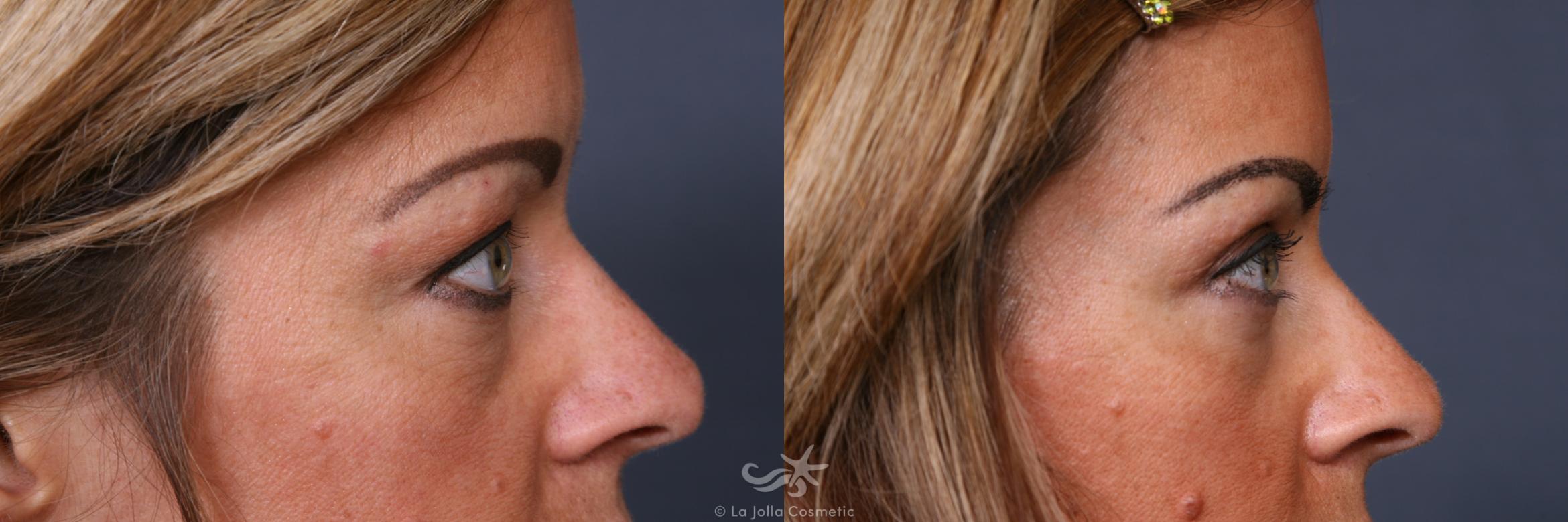 Before & After Eyelid Lift Result 357 Right Side View in San Diego, CA