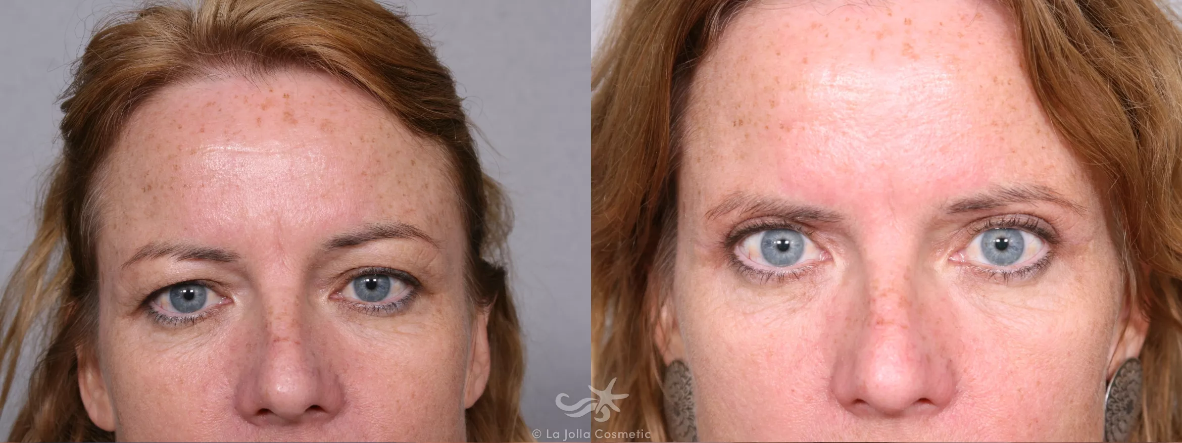 Before & After Eyelid Lift Result 366 Front View in San Diego, CA