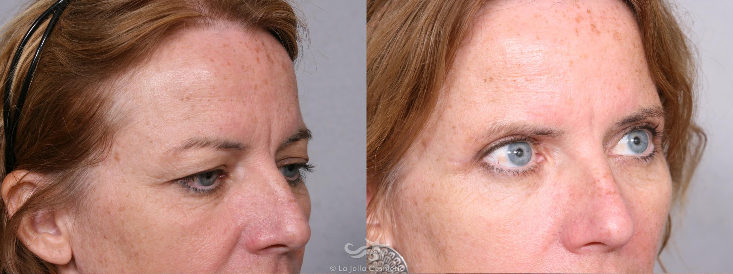 Before & After Eyelid Lift Result 366 Right Oblique View in San Diego, CA