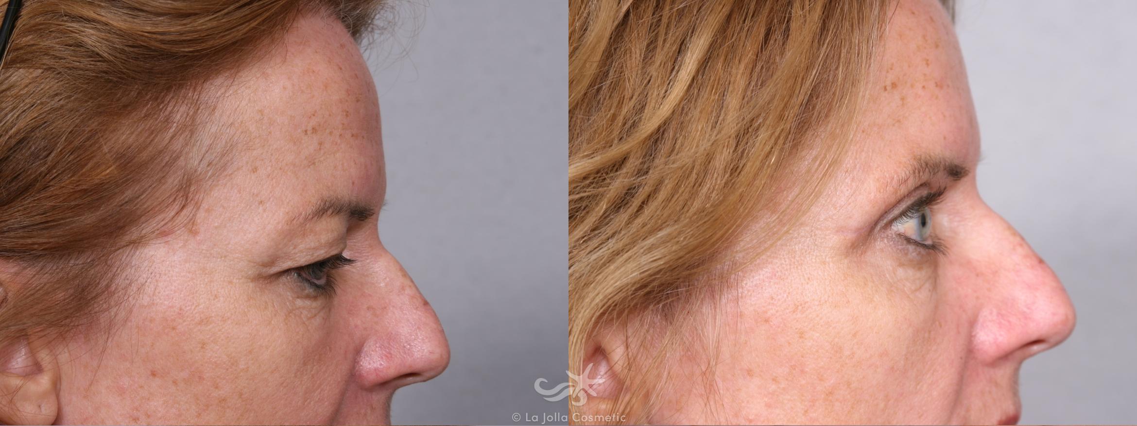 Before & After Eyelid Lift Result 366 Right Side View in San Diego, CA