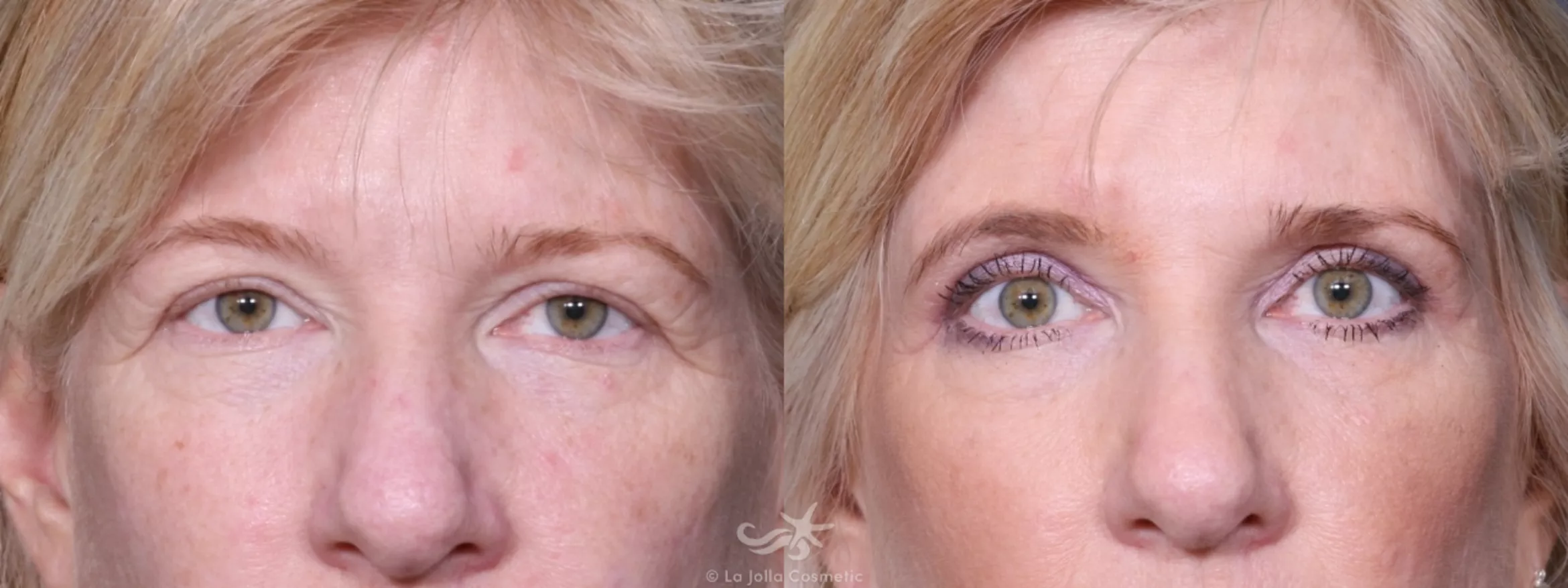 Before & After Eyelid Lift Result 399 Front View in San Diego, CA