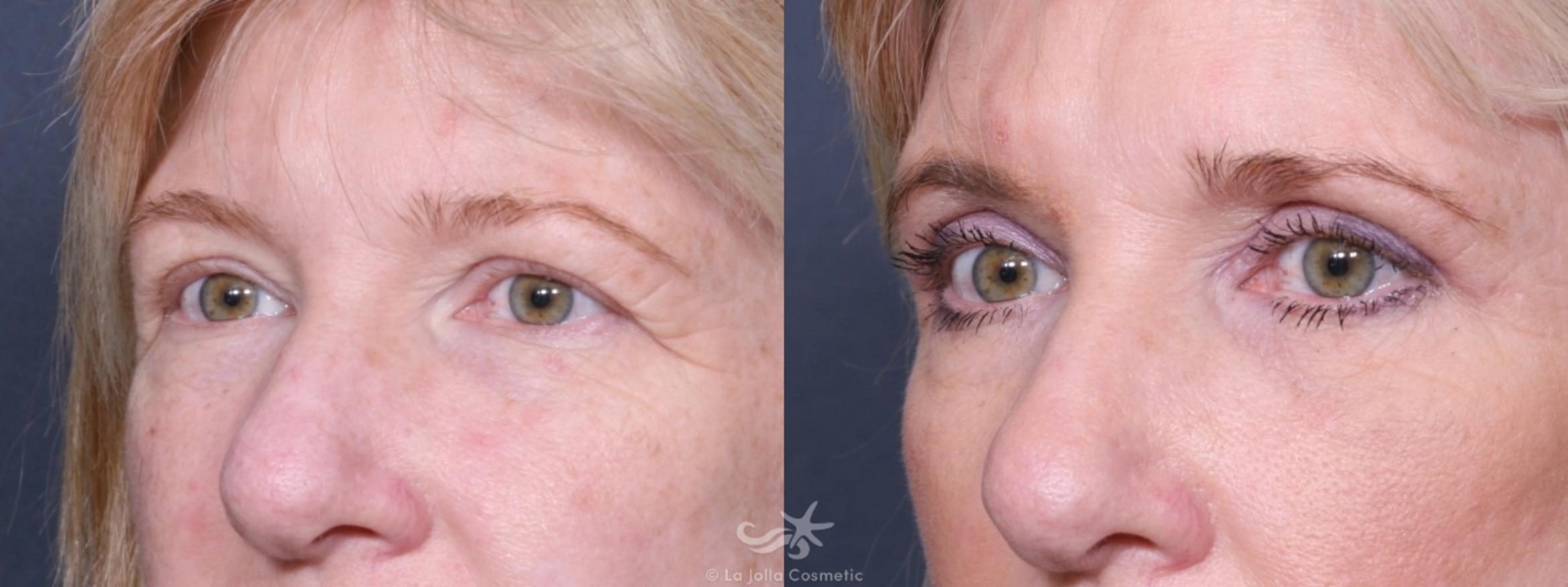 Before & After Eyelid Lift Result 399 Left Oblique View in San Diego, CA
