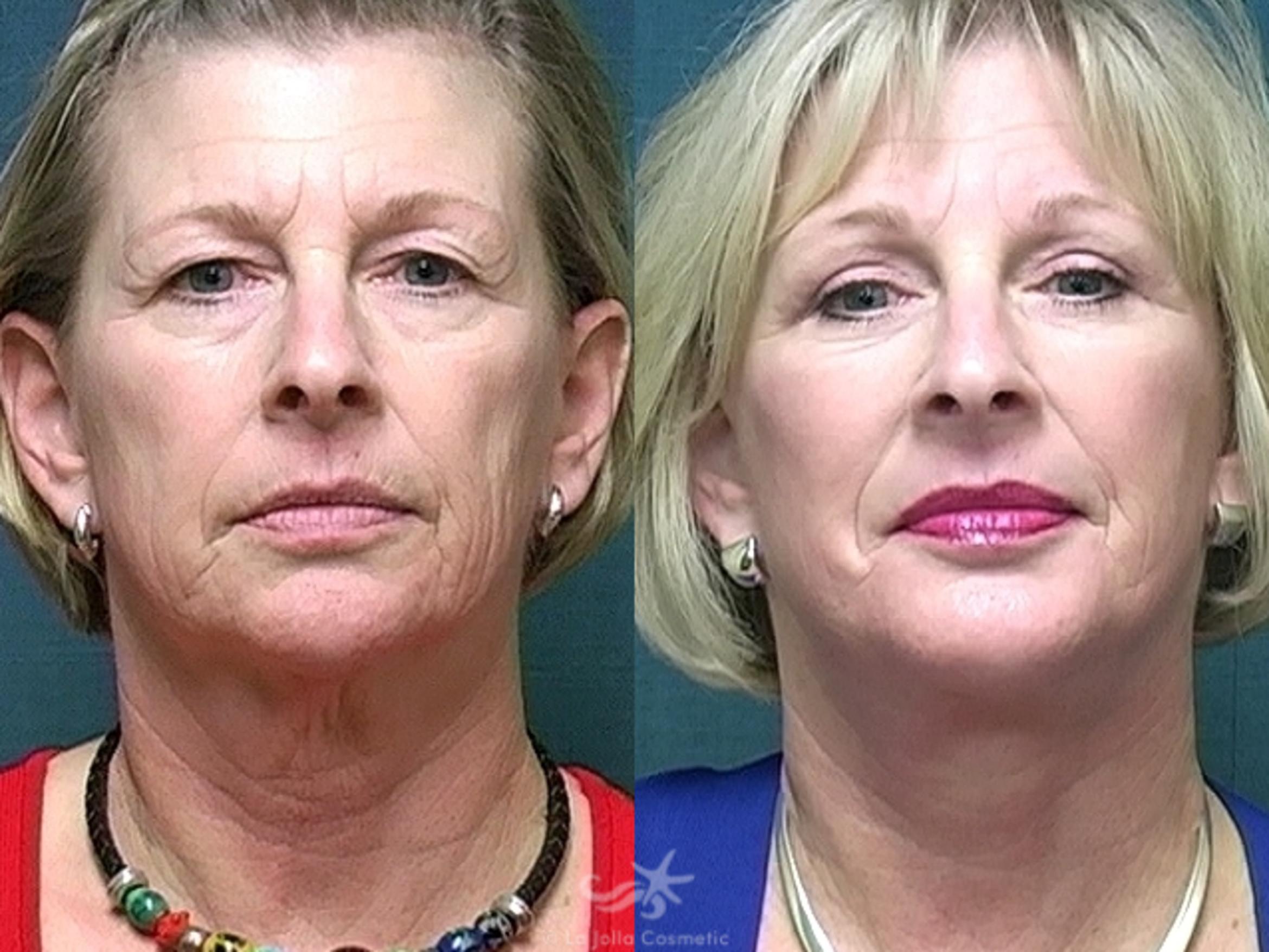 Before & After Facelift Result 431 Front View in San Diego, CA