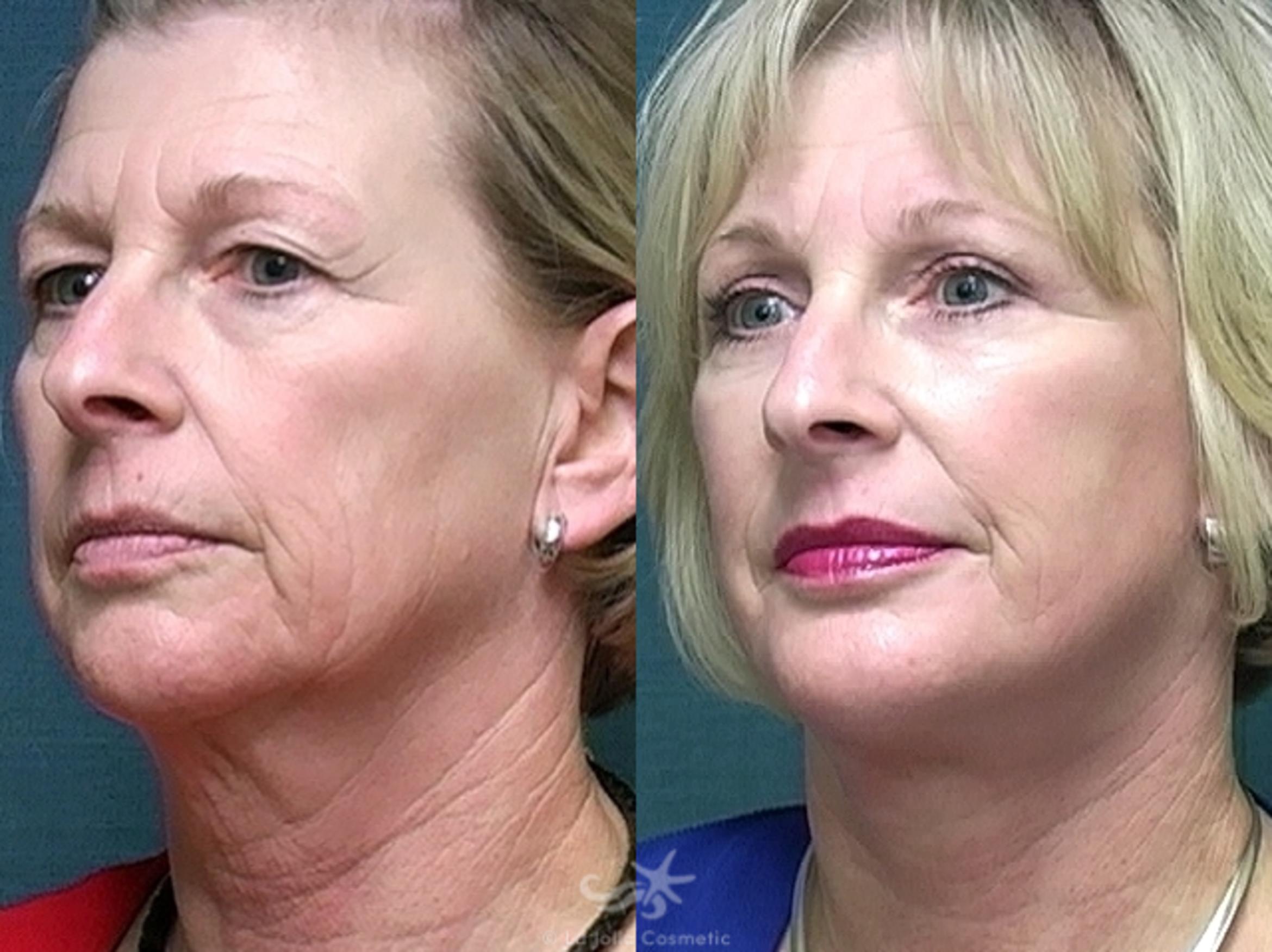 Before & After Facelift Result 431 Left Oblique View in San Diego, CA