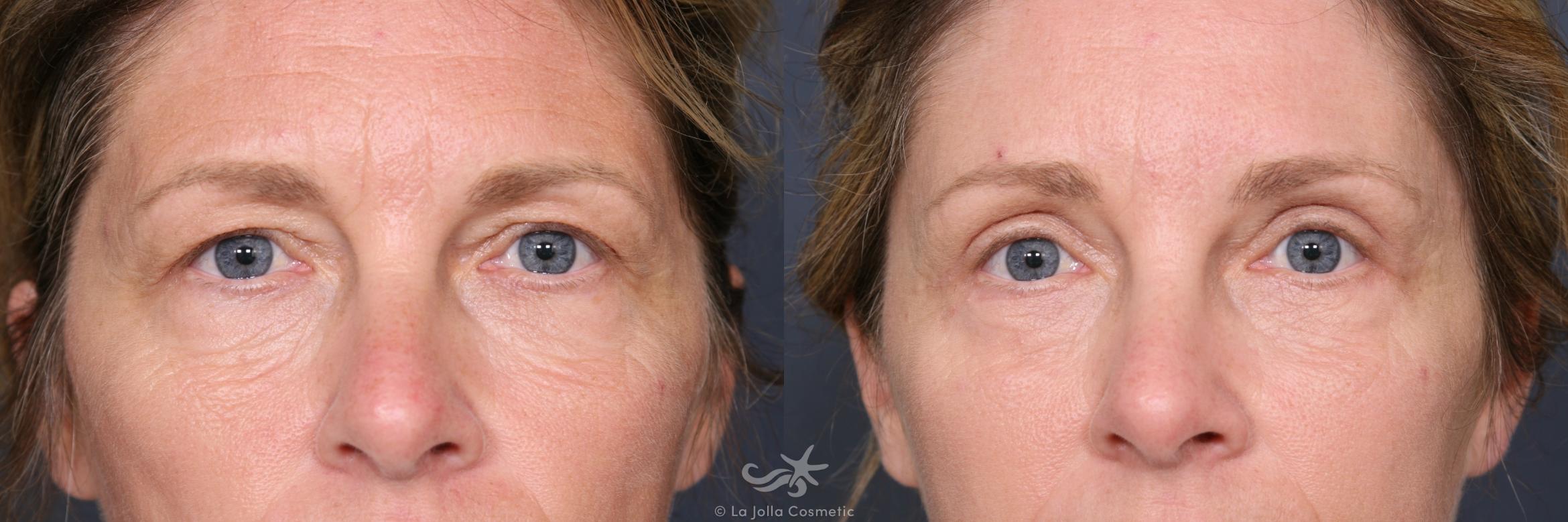 Before & After Eyelid Lift Result 460 Front View in San Diego, CA
