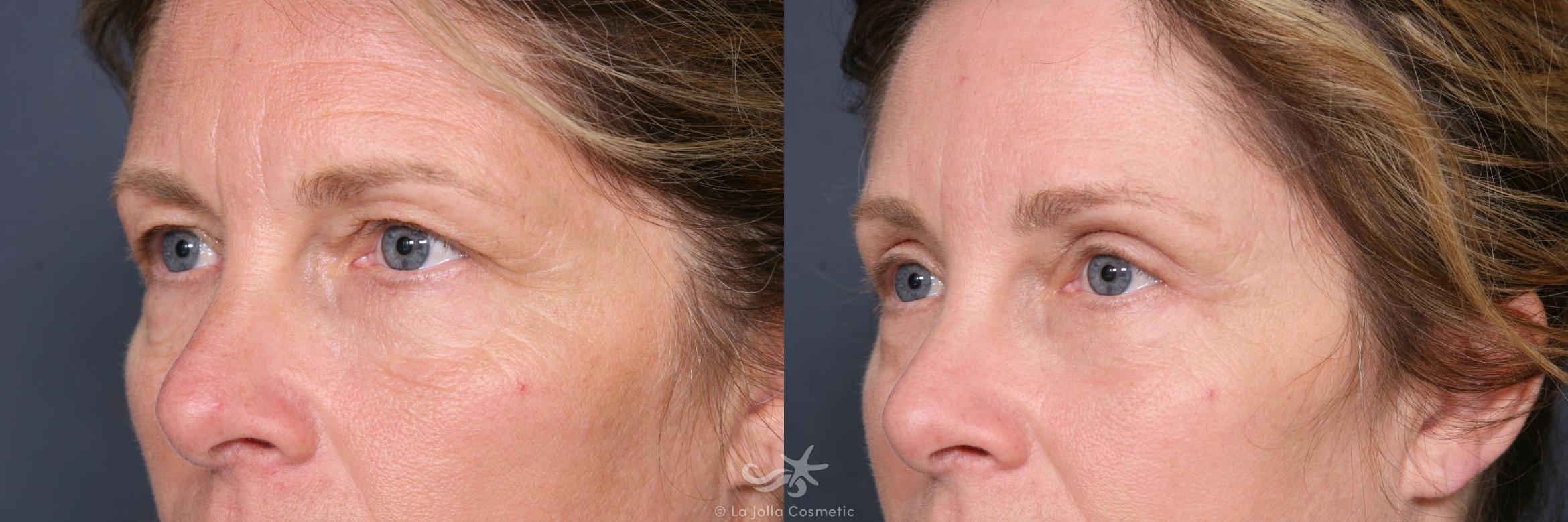 Before & After Eyelid Lift Result 460 Left Oblique View in San Diego, CA