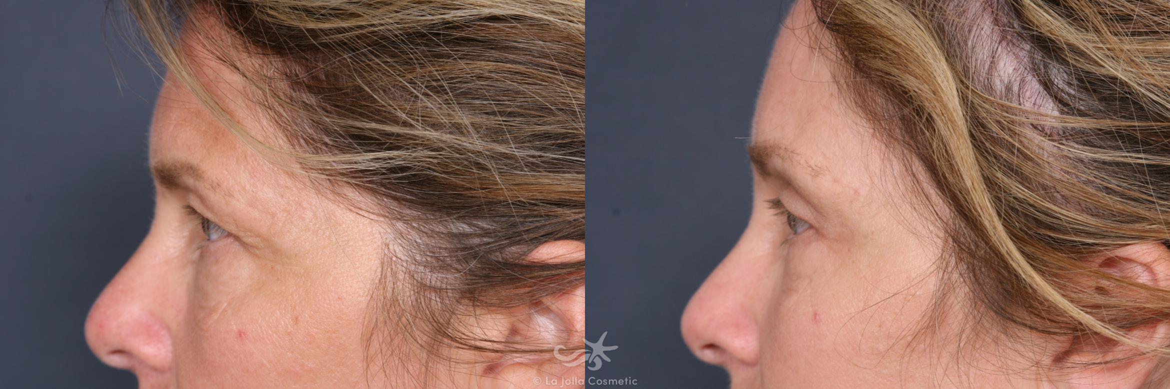Before & After Eyelid Lift Result 460 Left Side View in San Diego, CA