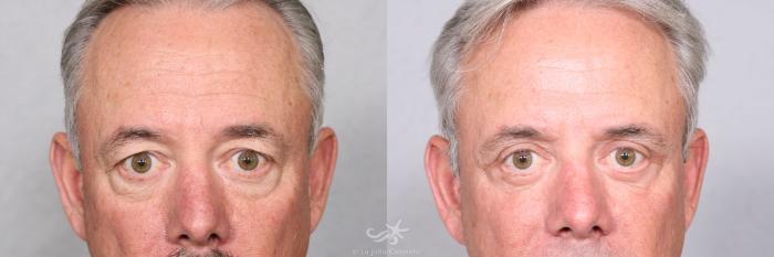 Before & After Eyelid Lift Result 462 Front View in San Diego, Carlsbad, CA
